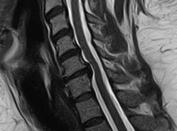 Chiropractic Adjustments and IVD Herniations
